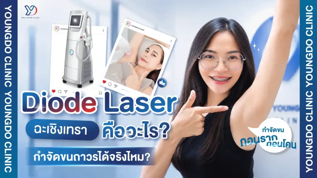 โปรแกรม Diode Laser ฉะเชิงเทรา คืออะไร? กำจัดขนถาวรได้จริงไหม