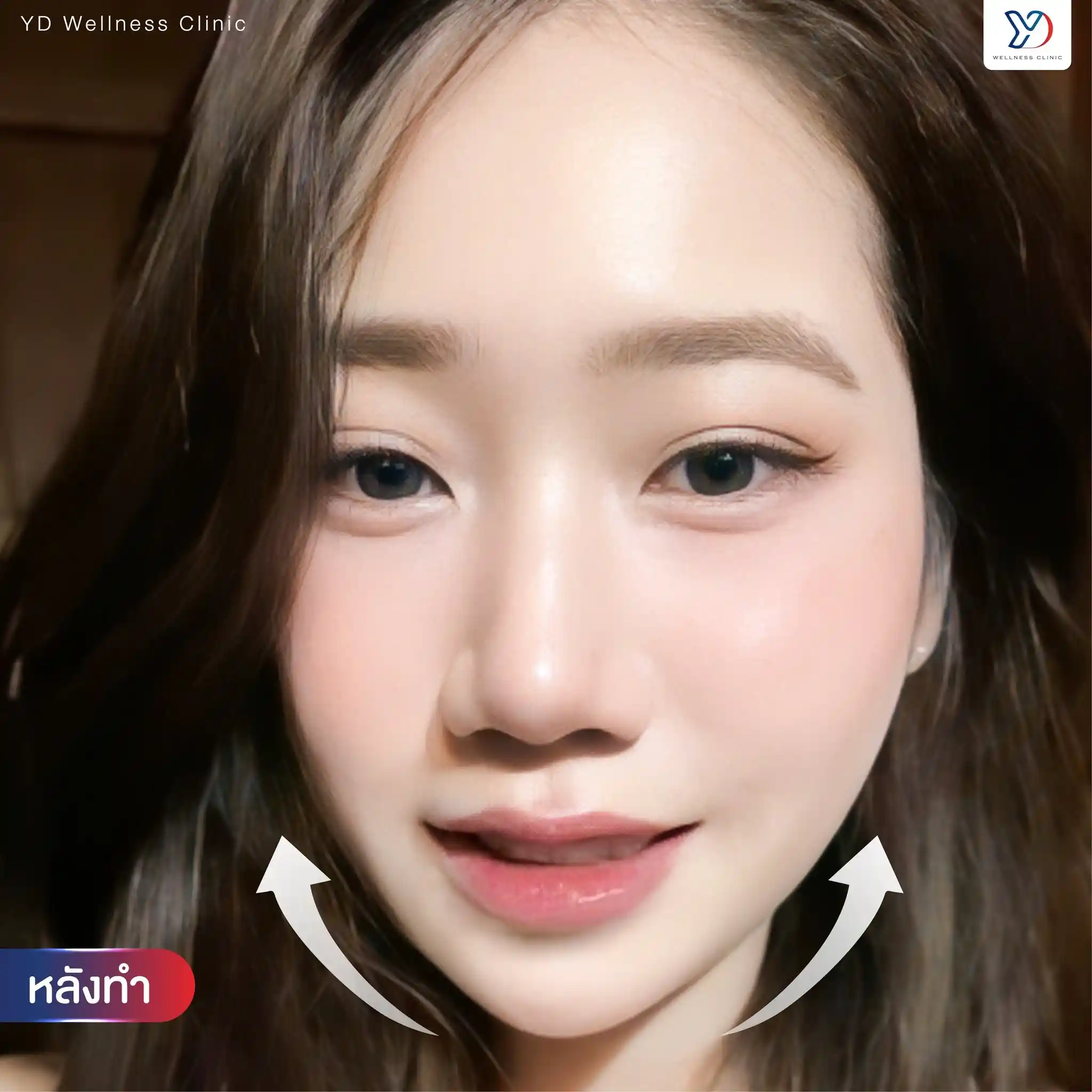 เทรนด์หน้ายุง ปราจีน คืออะไร