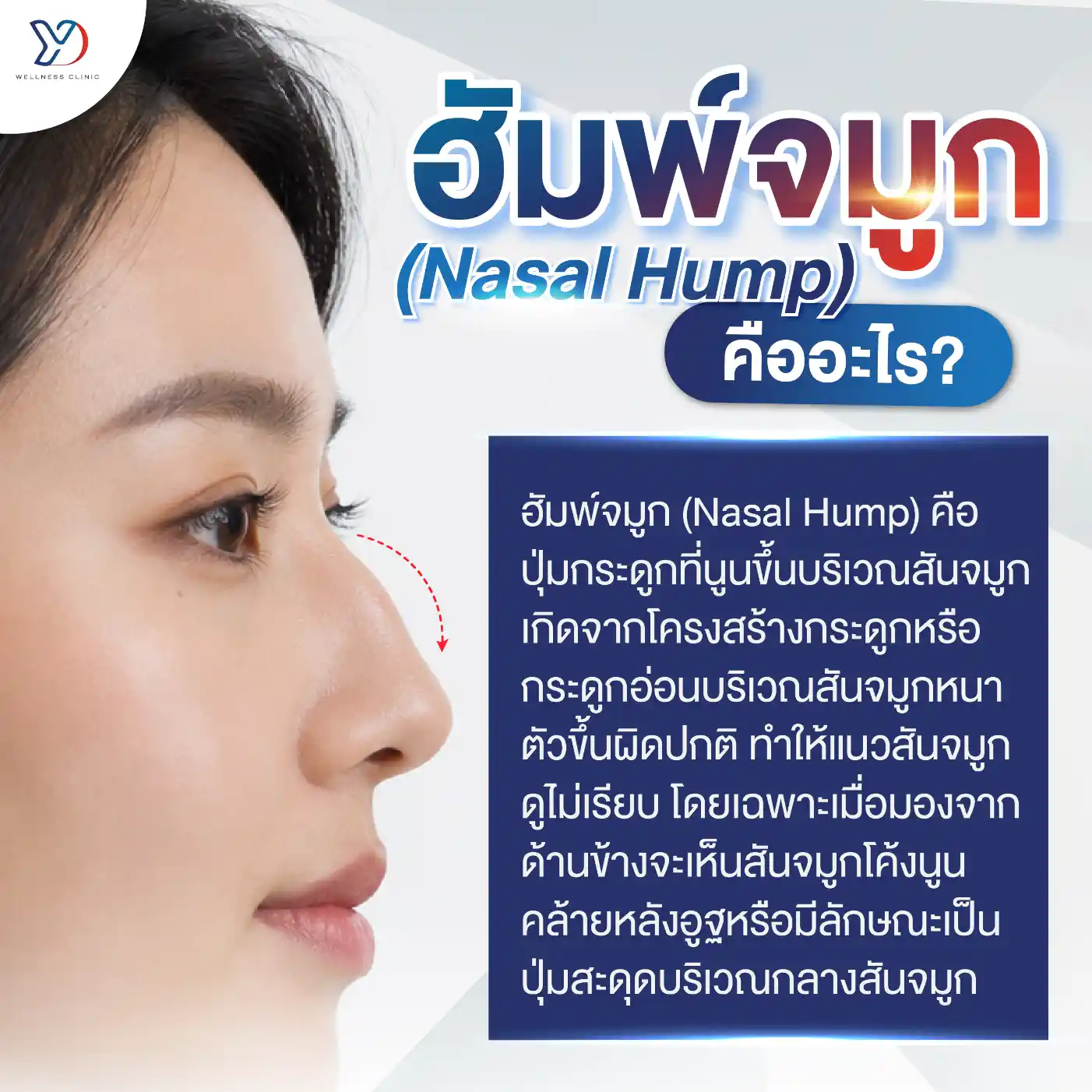 ฮัมพ์จมูก (Nasal Hump) คืออะไร