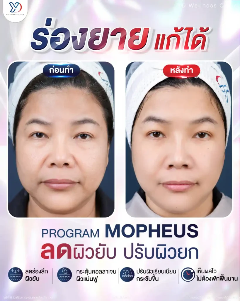 รีวิว Morpheus8 Burst 01
