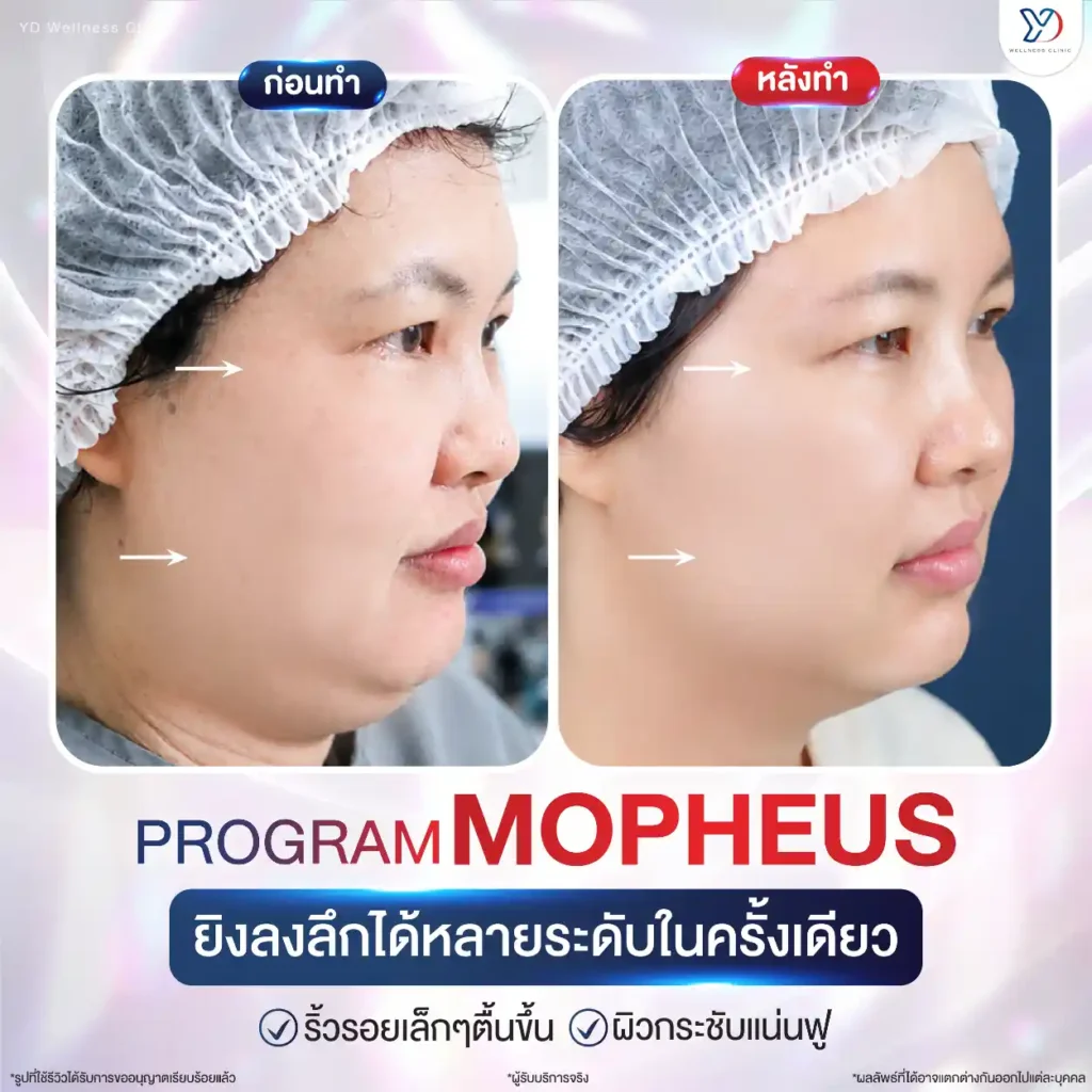 รีวิว Morpheus8 Burst 02