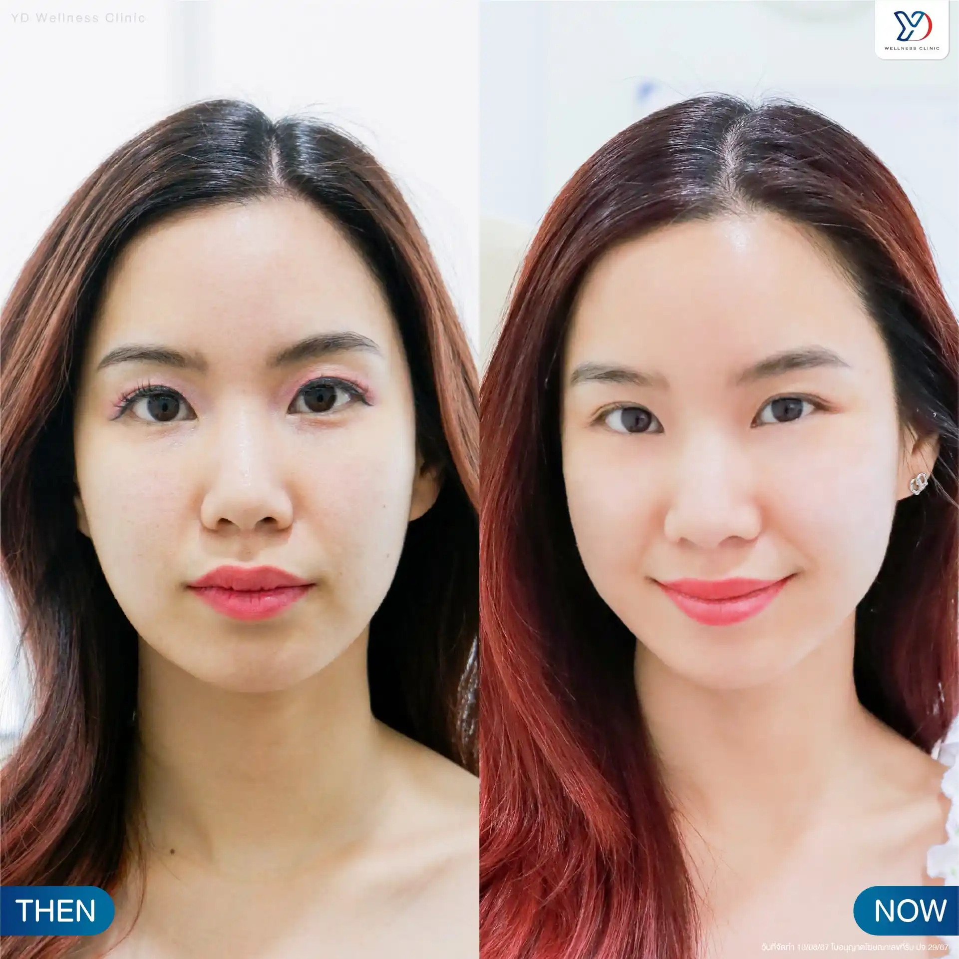 Skin Booster สระแก้ว ช่วยเรื่องอะไรบ้าง