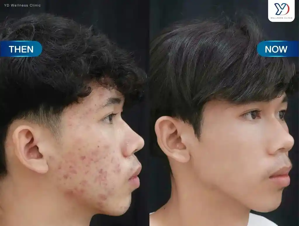 คุณกำลังเจอกับสิวประเภทไหนอยู่