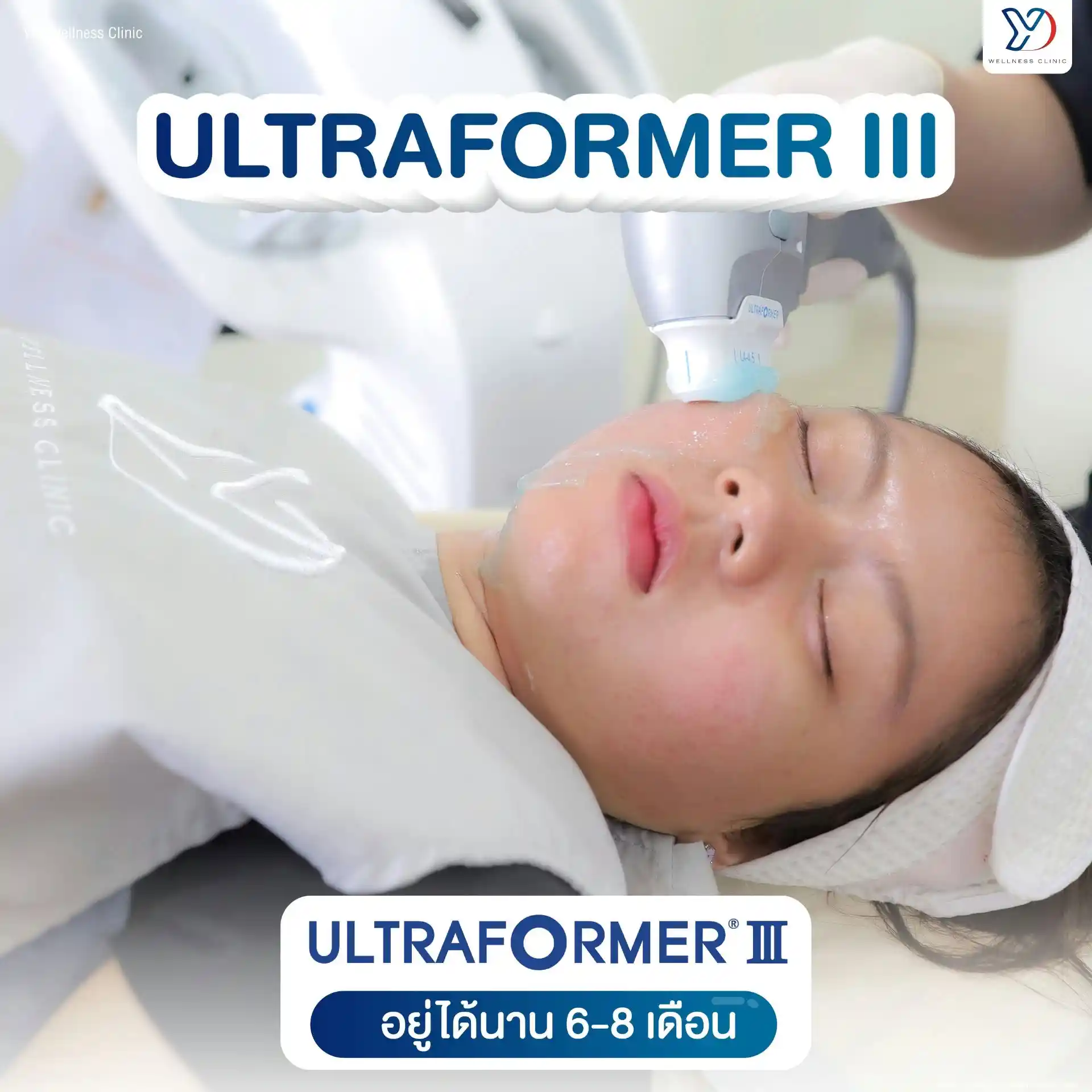หลังทำโปรแกรม Ultraformer III กี่วันเริ่มเข้าที่