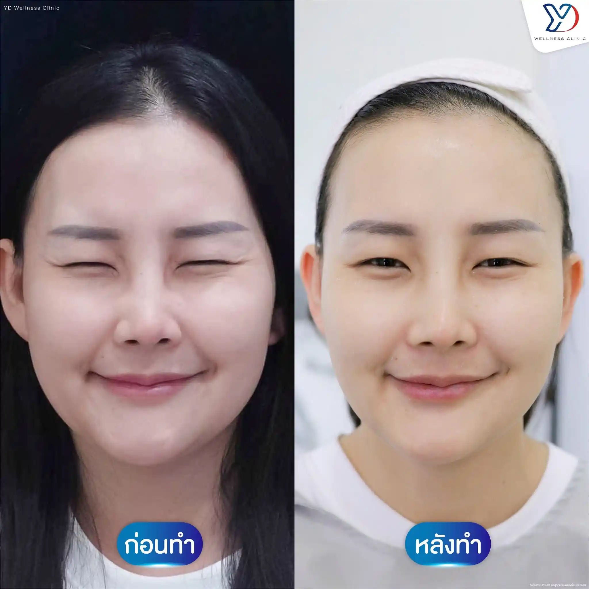 Hutox Botox ช่วยดูแลปัญหาอะไรได้บ้าง