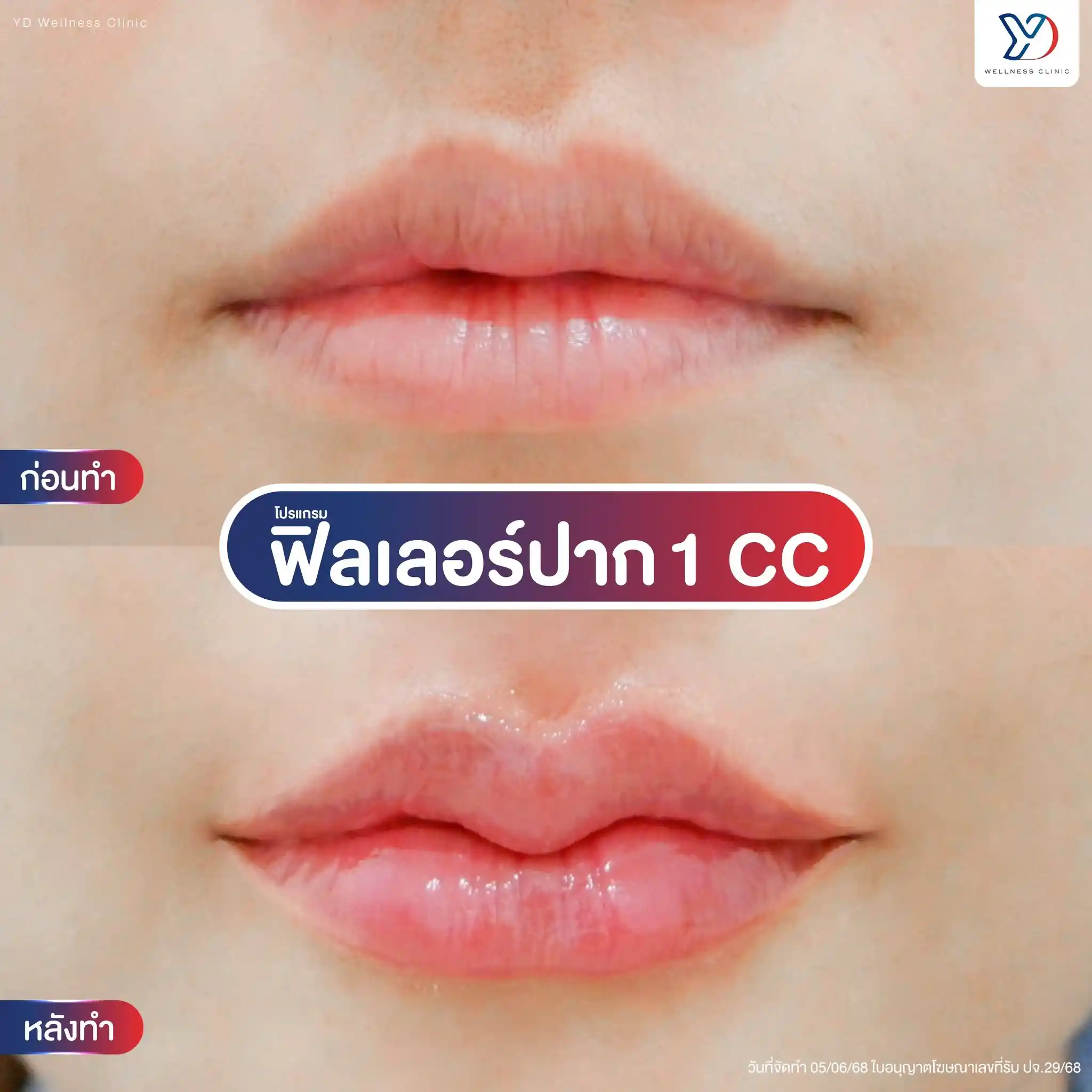 ฉีดปาก 1 cc ปราจีน เลือกทรงปากแบบไหนได้บ้าง