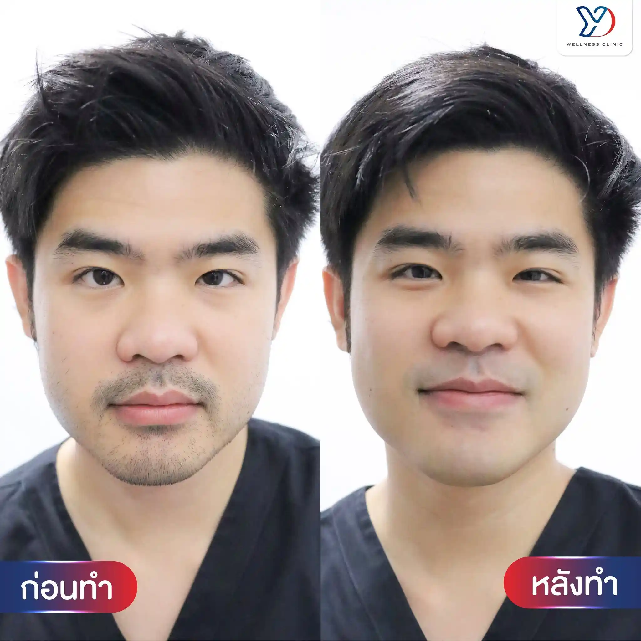 แว็กซ์หนวด เครา และคาง