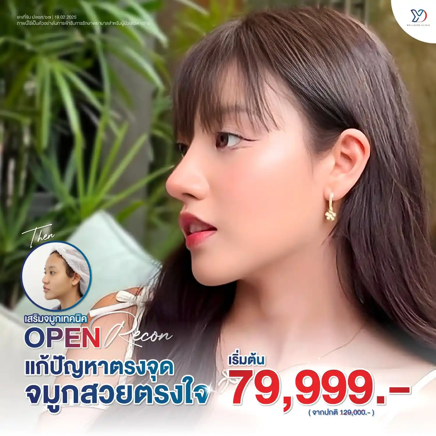 เทคนิค Open (เปิดโครงสร้างจมูก)