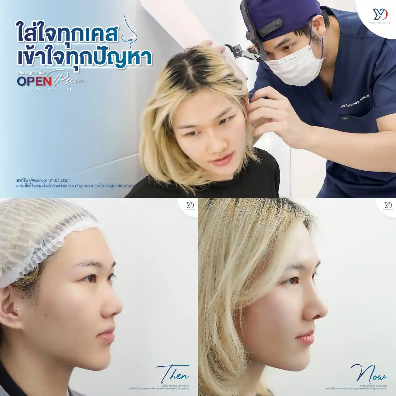 เสริมจมูกพร้อมรองปลายด้วยกระดูกอ่อนหลังหู