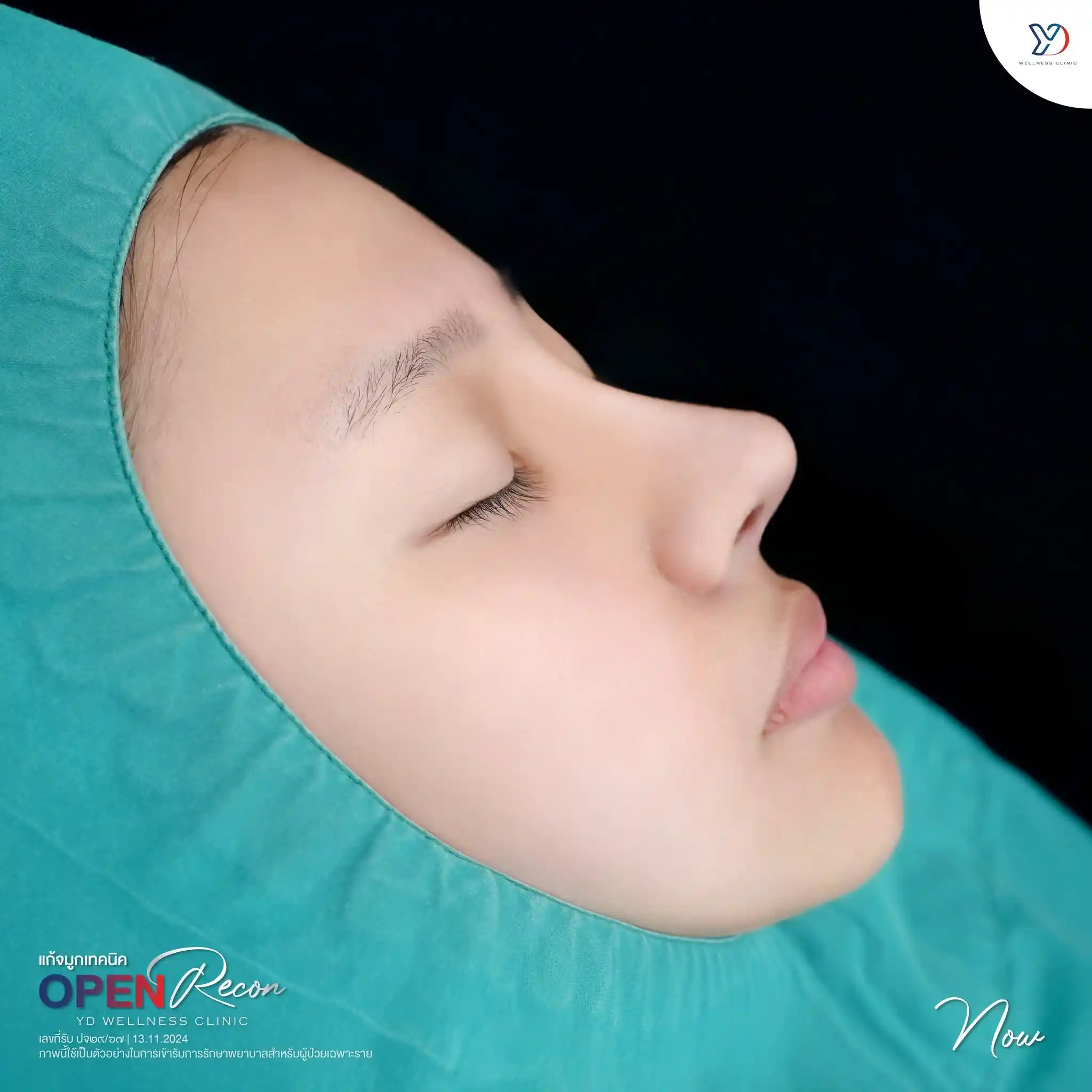 ทรงจมูก พสจีน คืออะไร