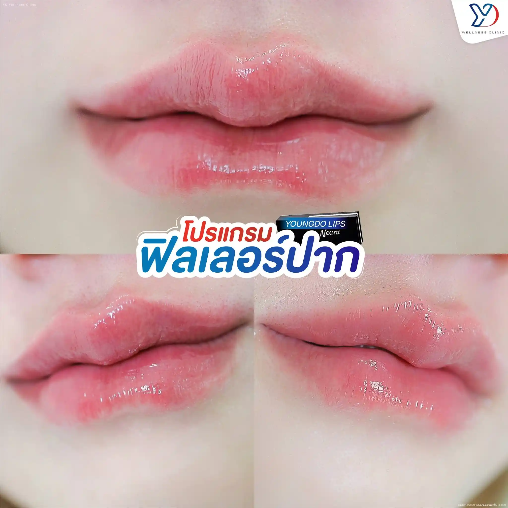 โปรแกรมฟิลเลอร์ปาก คืออะไร