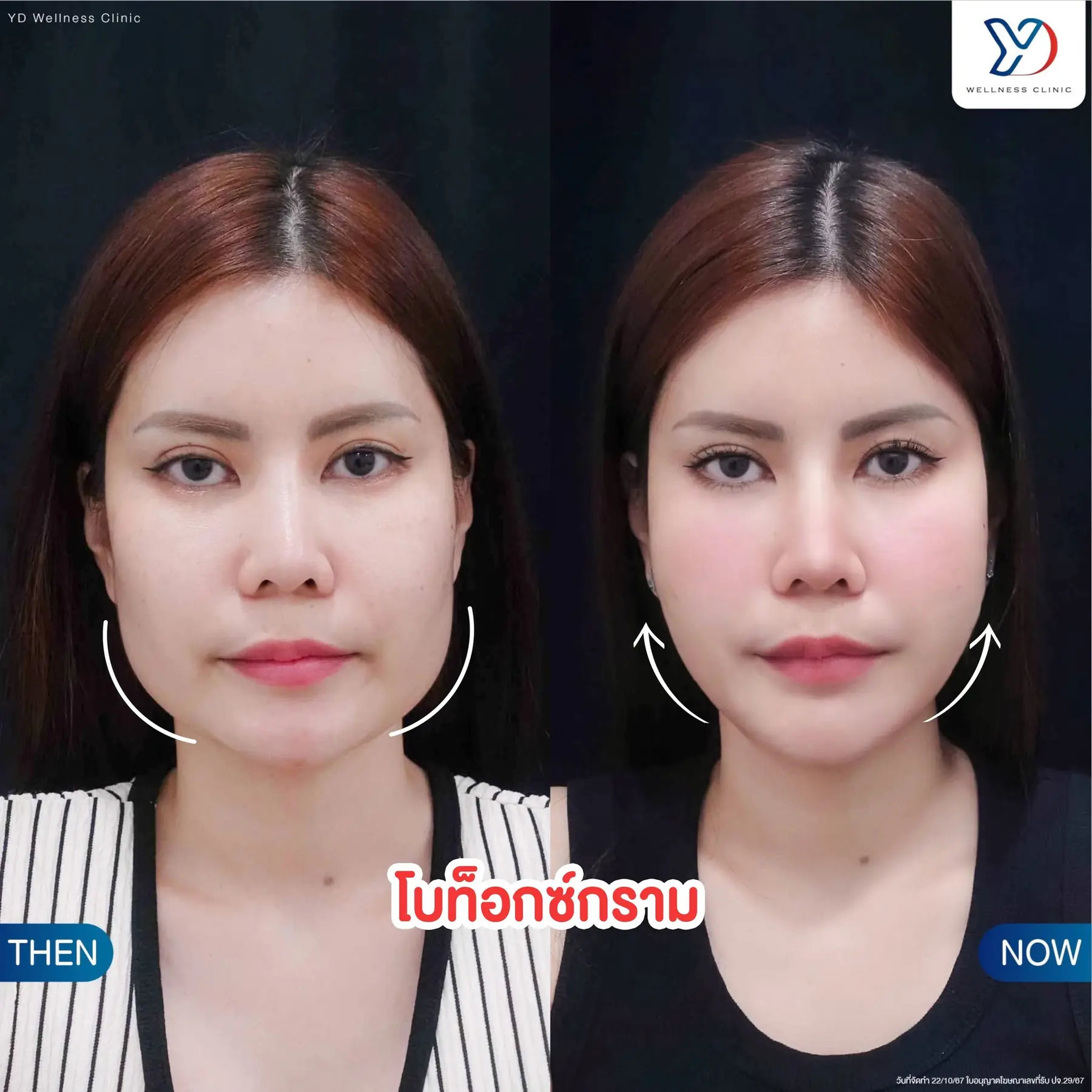 รีวิวฟิลเลอร์และโบท็อกซ์ 01