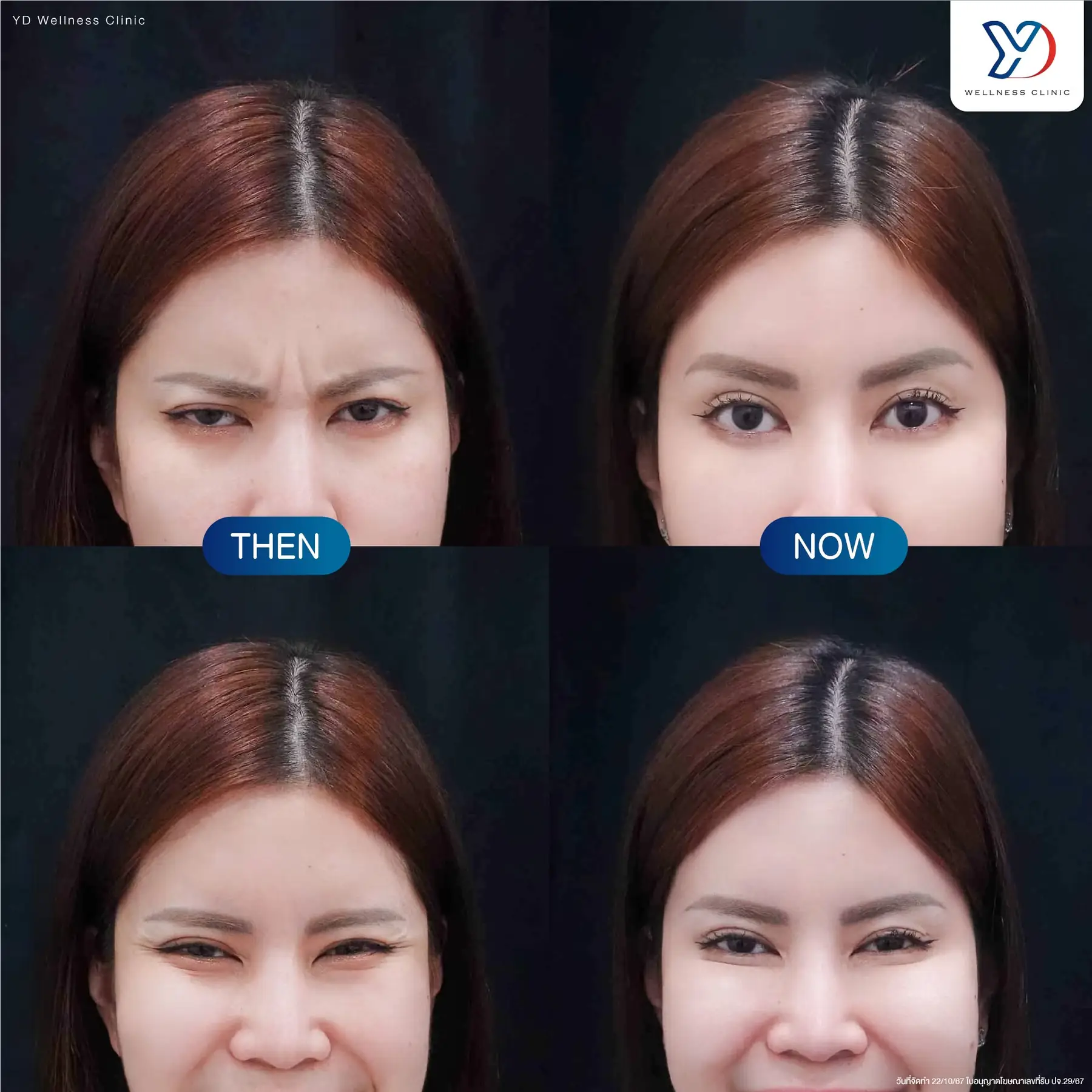 รีวิวฟิลเลอร์และโบท็อกซ์ 02