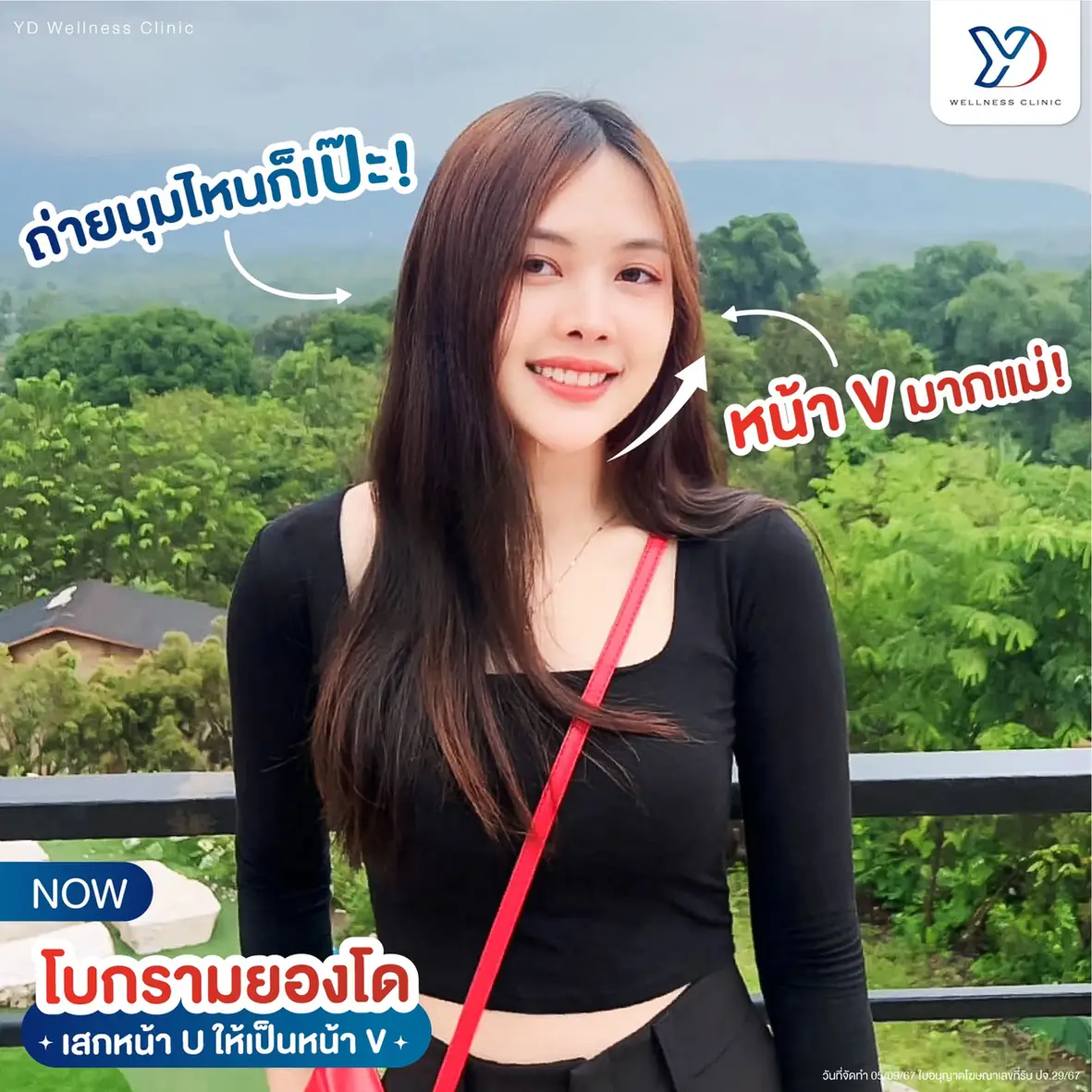 รีวิวฟิลเลอร์และโบท็อกซ์ 03