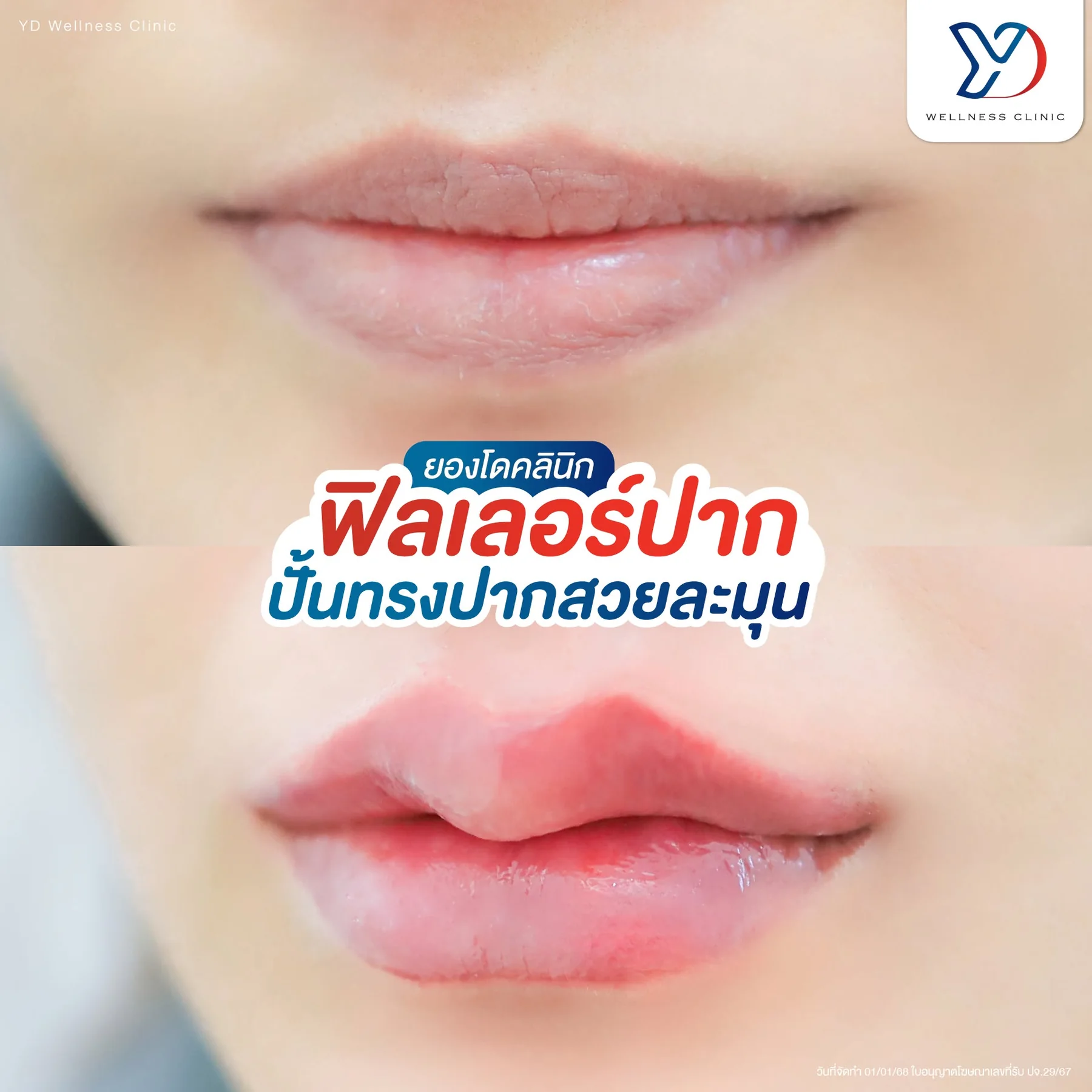 รีวิวฟิลเลอร์และโบท็อกซ์ 04
