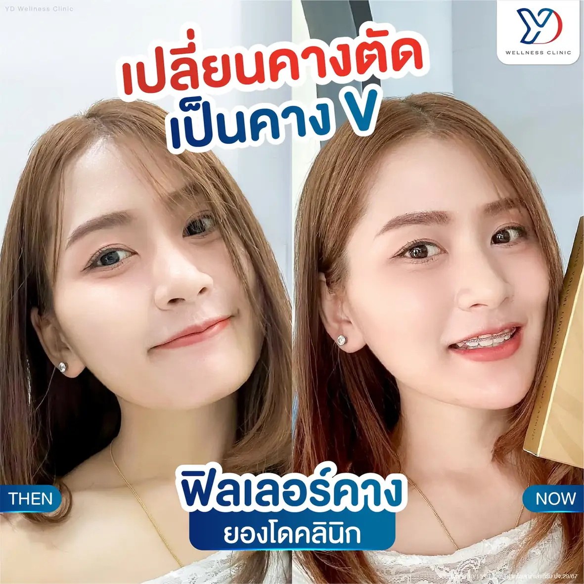 รีวิวฟิลเลอร์และโบท็อกซ์ 05