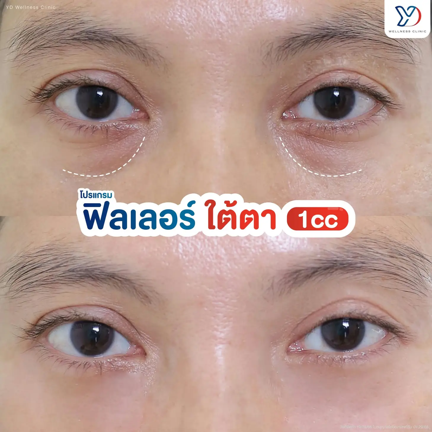 รีวิวฟิลเลอร์และโบท็อกซ์ 06
