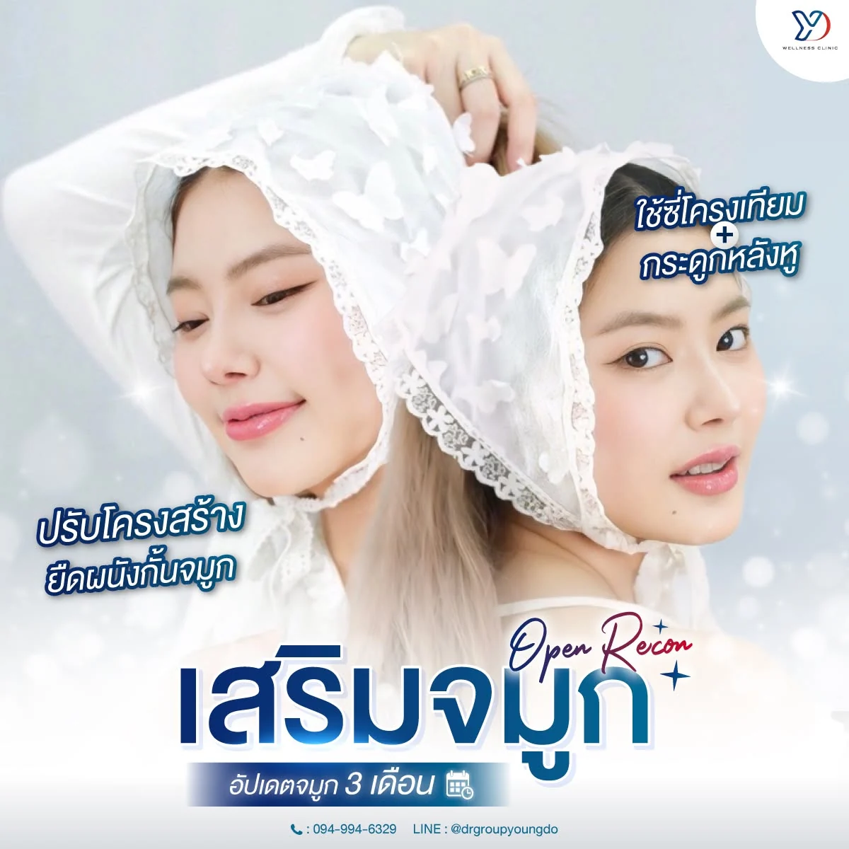 รีวิวเสริมจมูกเทคนิค OPEN เสริมกระดูกอ่อนหู 01