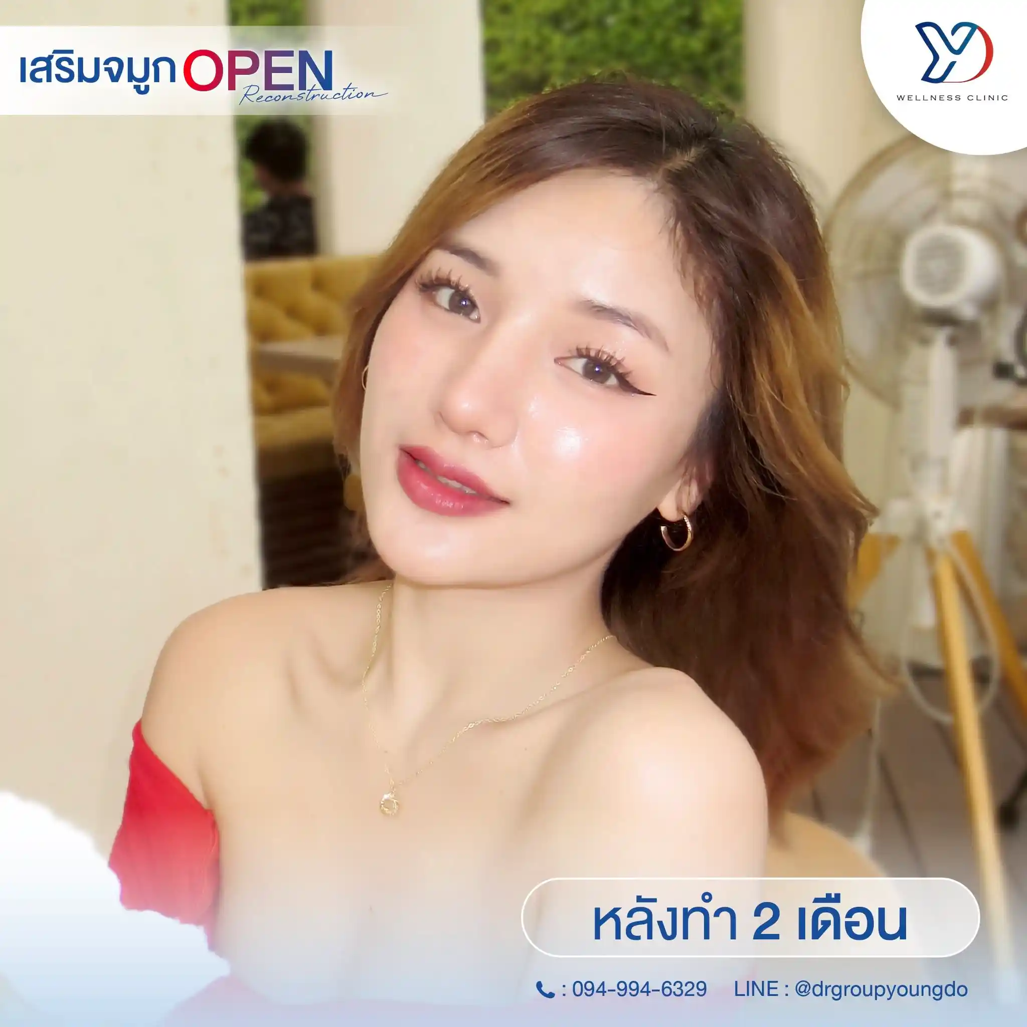 รีวิวเสริมจมูกเทคนิค OPEN เสริมกระดูกอ่อนหู 03