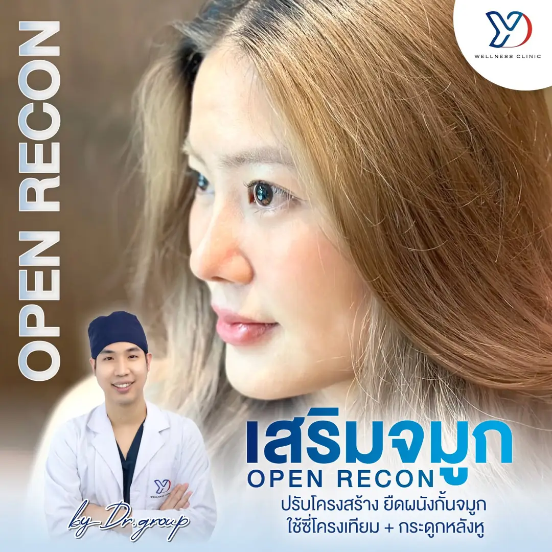 รีวิวเสริมจมูกเทคนิค OPEN เสริมกระดูกอ่อนหู 04