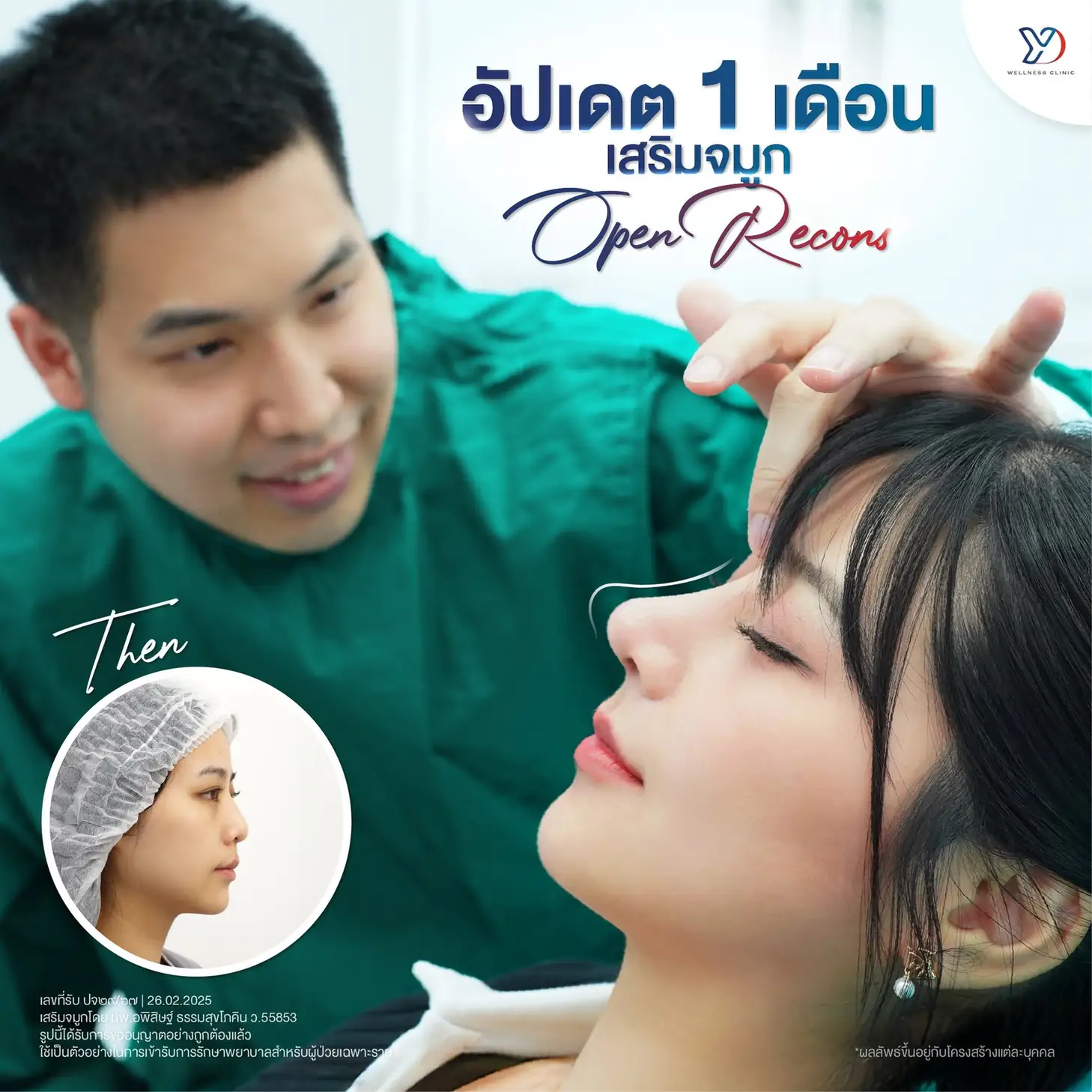 รีวิวเสริมจมูกเทคนิค OPEN เสริมกระดูกอ่อนหู 05