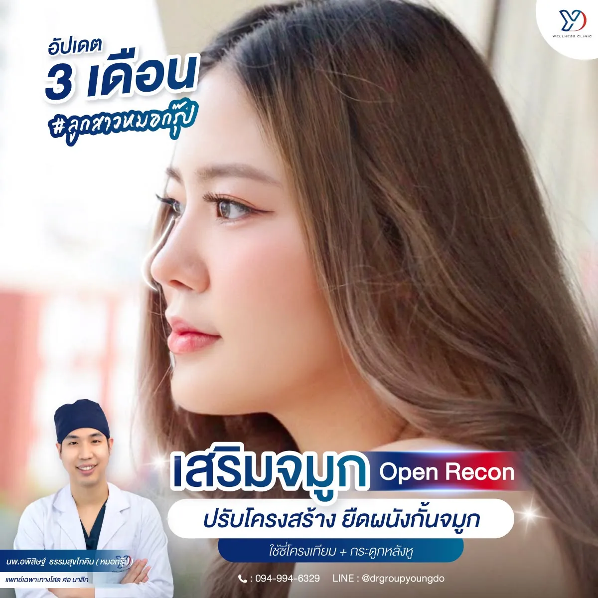 รีวิวเสริมจมูกเทคนิค OPEN เสริมกระดูกอ่อนหู 06