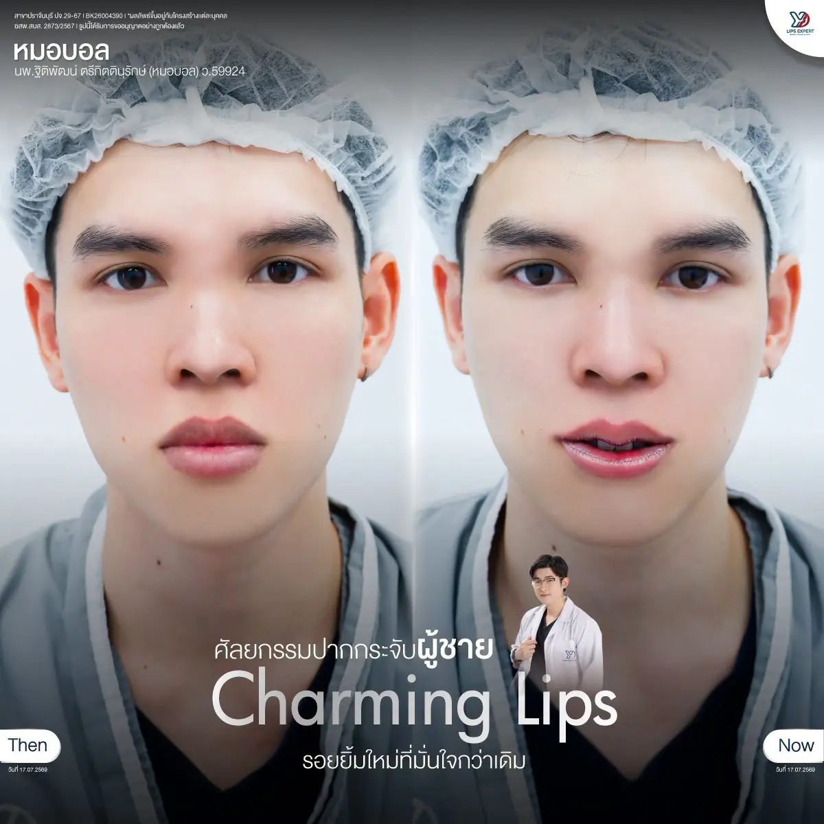 รีวิวปากกระจับผู้ชาย 02