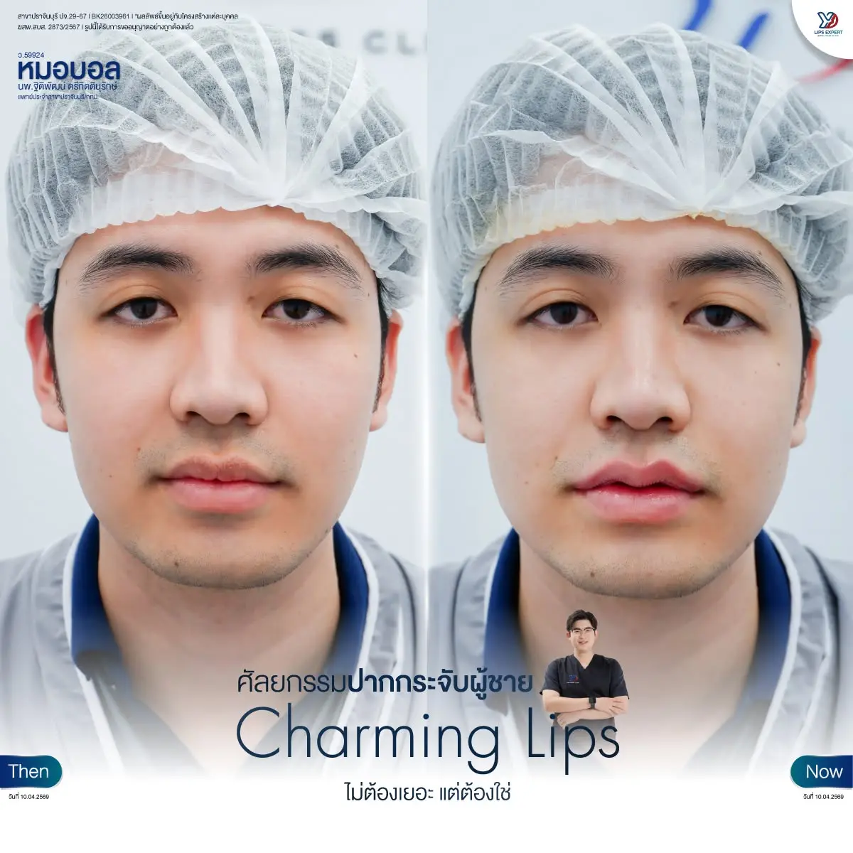 รีวิวปากกระจับผู้ชาย 03