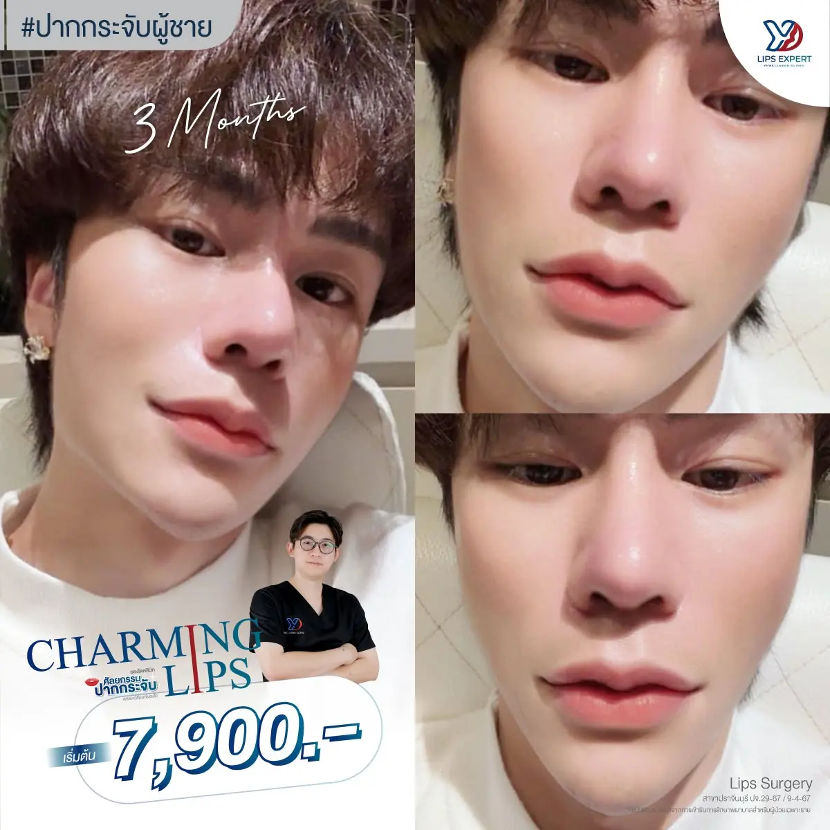 รีวิวปากกระจับผู้ชาย 04