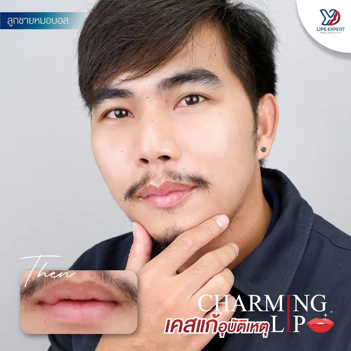 รีวิวปากกระจับผู้ชาย 06