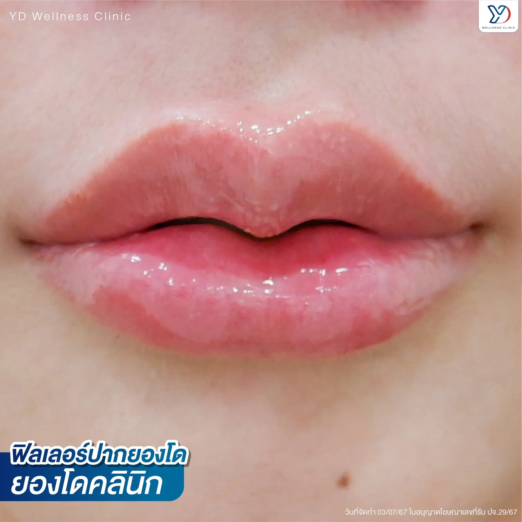 รีวิวฟิลเลอร์ปากสายฝอ 01