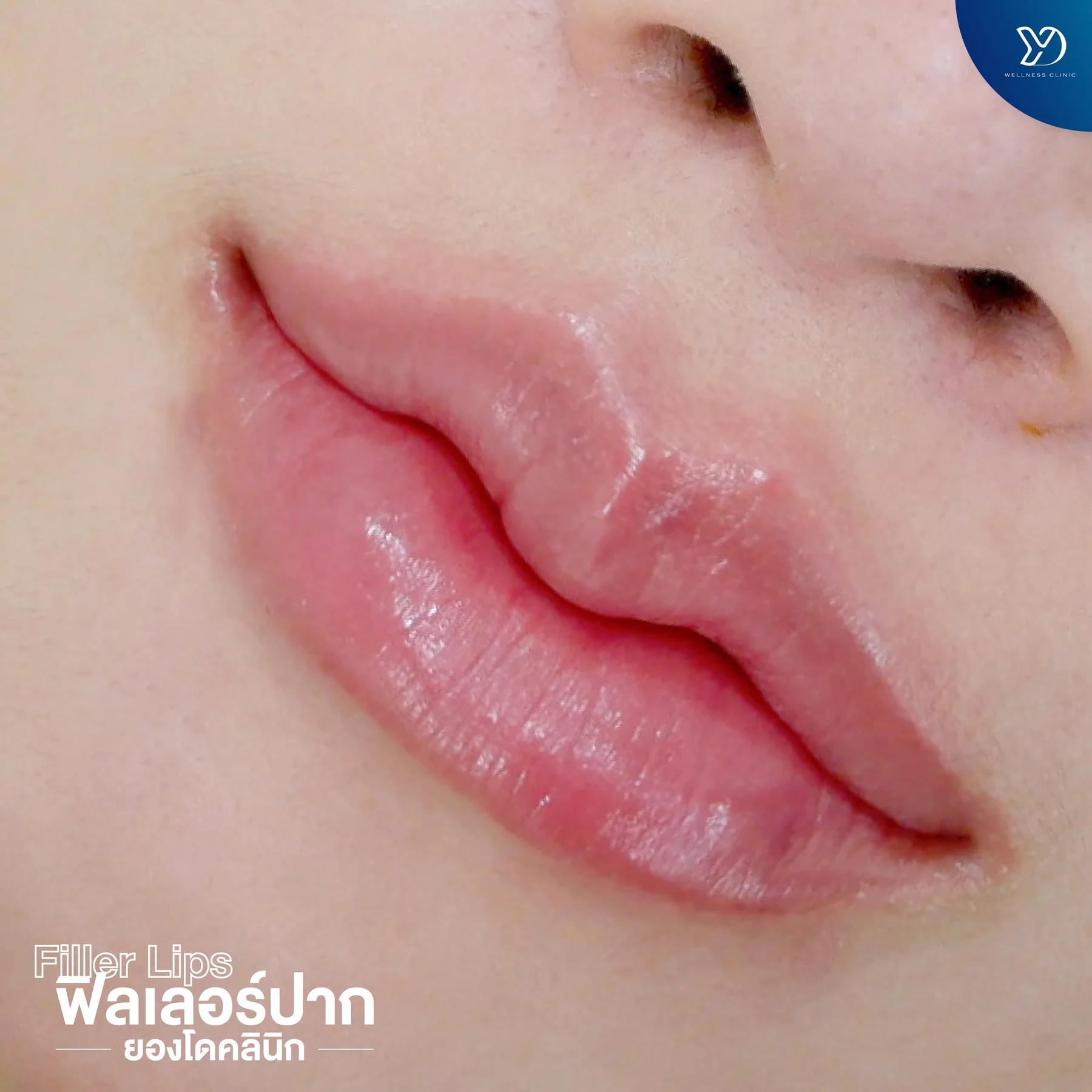 รีวิวฟิลเลอร์ปากสายฝอ 02