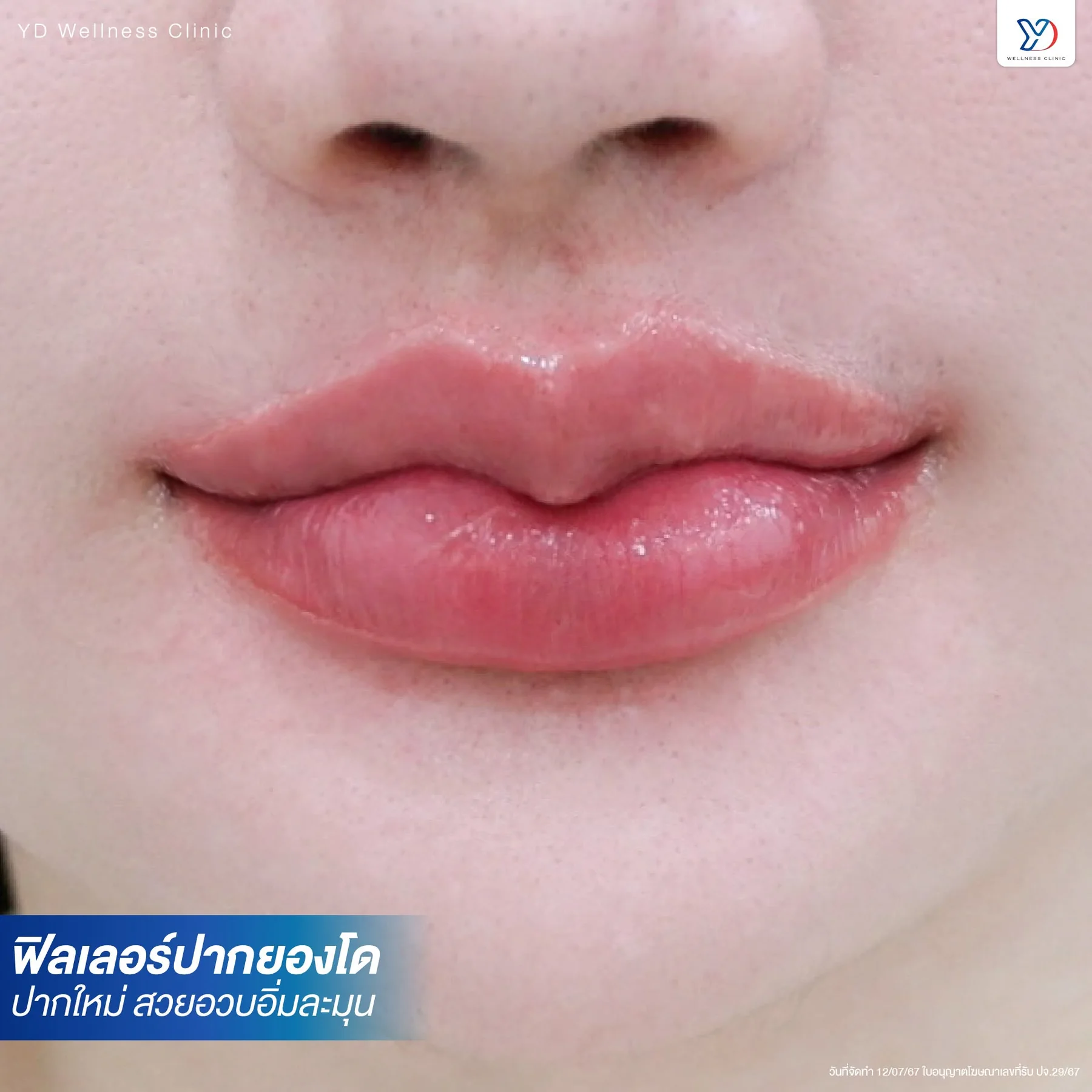 รีวิวฟิลเลอร์ปากสายฝอ 04
