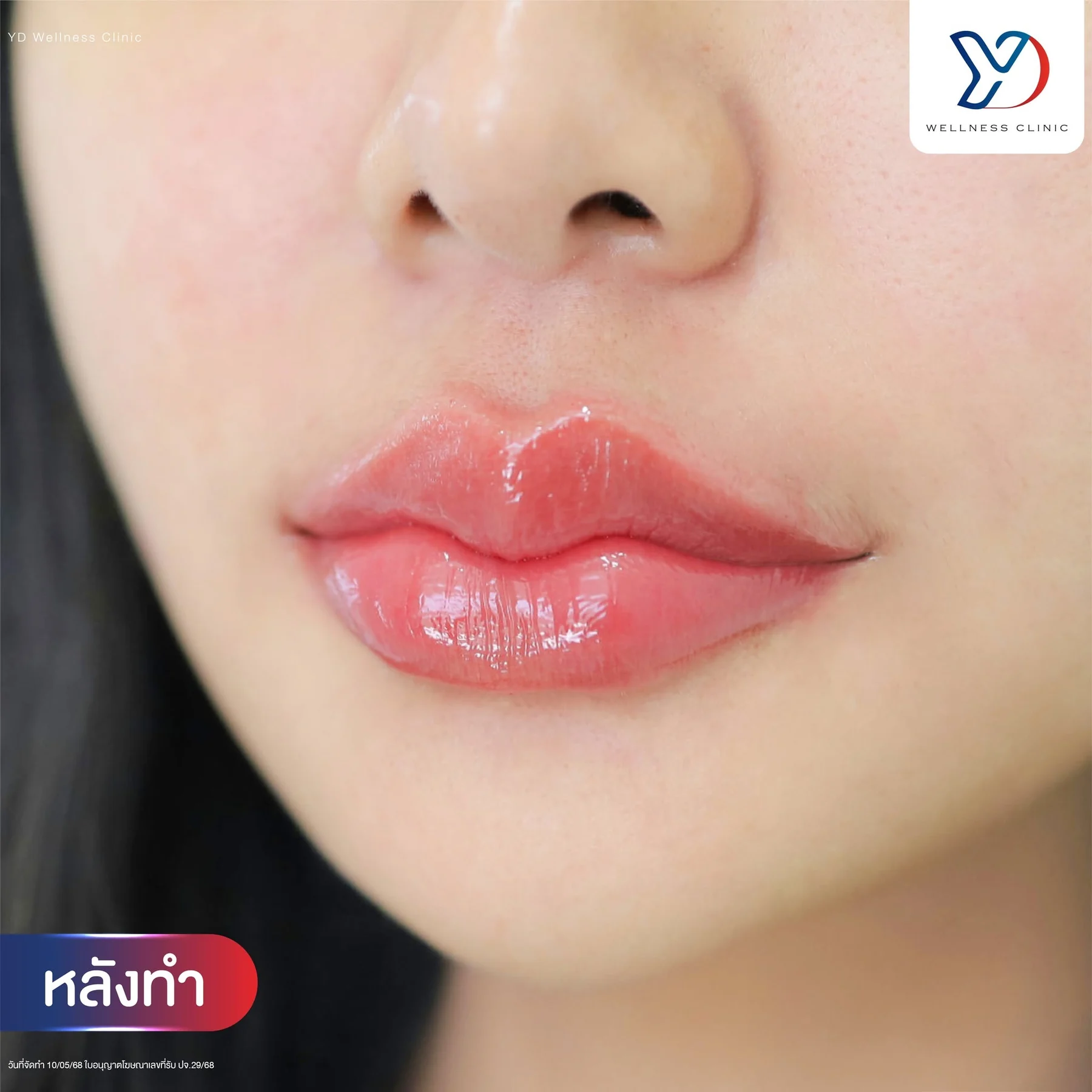 รีวิวฟิลเลอร์ปากสายฝอ 05