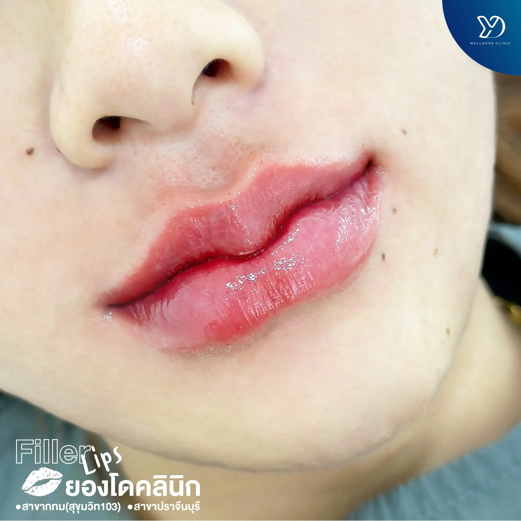 รีวิวฟิลเลอร์ปากสายฝอ 06