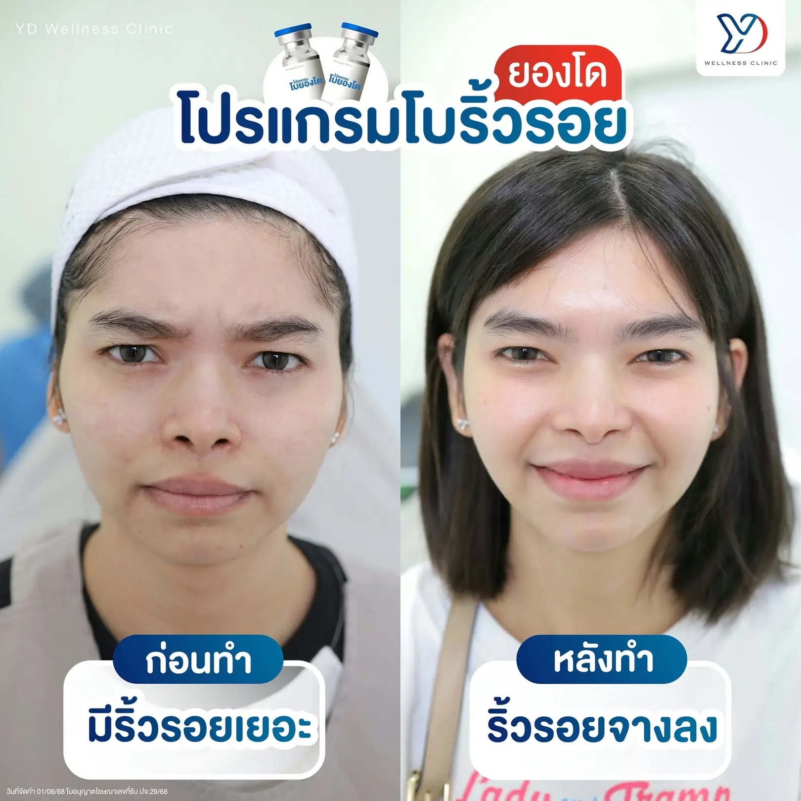โบท็อกซ์ช่วยเรื่องอะไรบ้าง