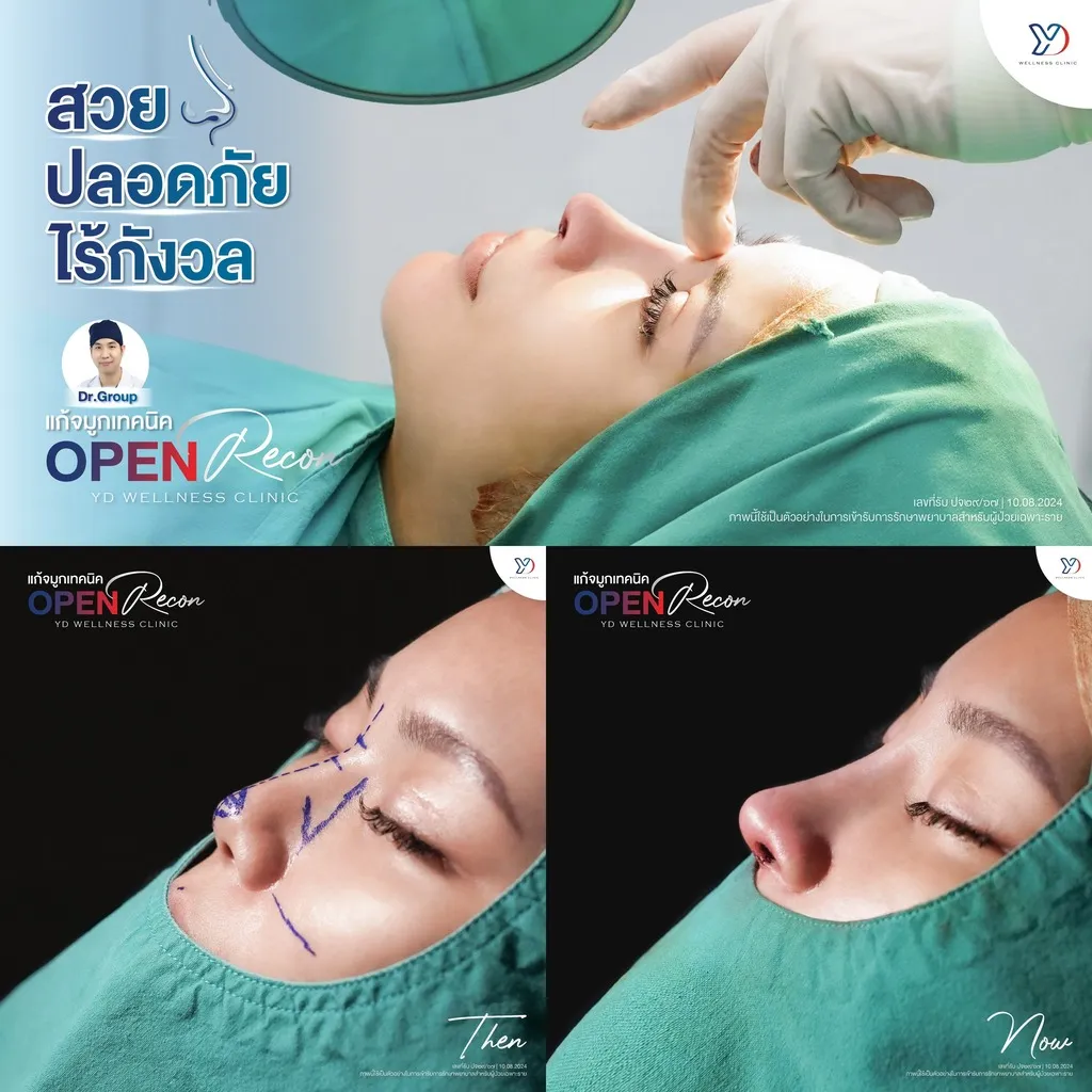 ขั้นตอนการเสริมจมูกด้วยกระดูกอ่อนหลังหู