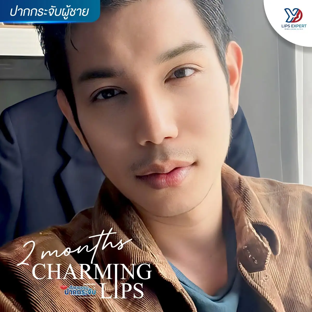 ทำปากกระจับผู้ชาย