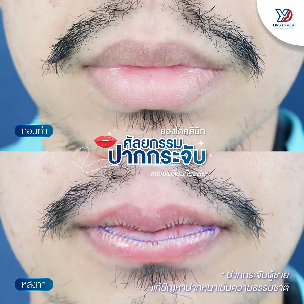 วิธีปรับทรงปากผู้ชาย