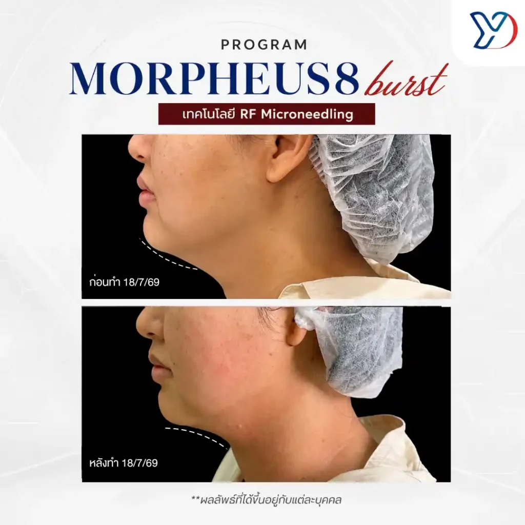 รีวิว mopheus8 bust 03