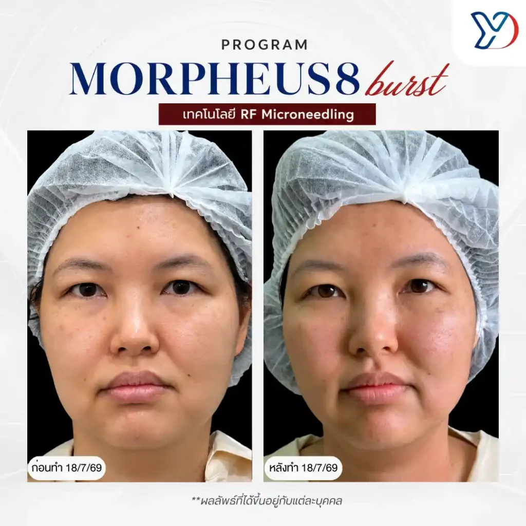รีวิว mopheus8 bust 04