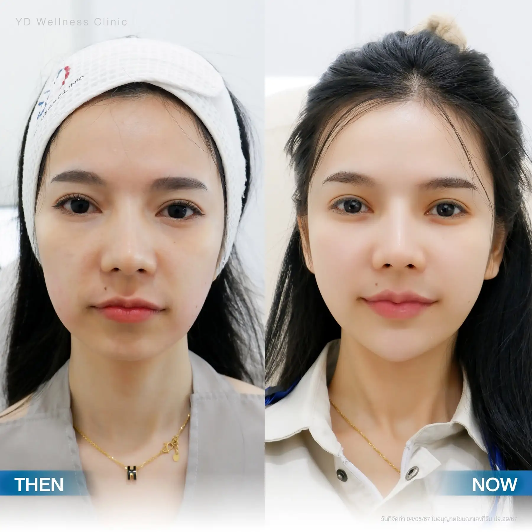 รีวิวโปรแกรมปรับหน้าอ่อนเยาว์ ที่ยองโด คลินิก 01