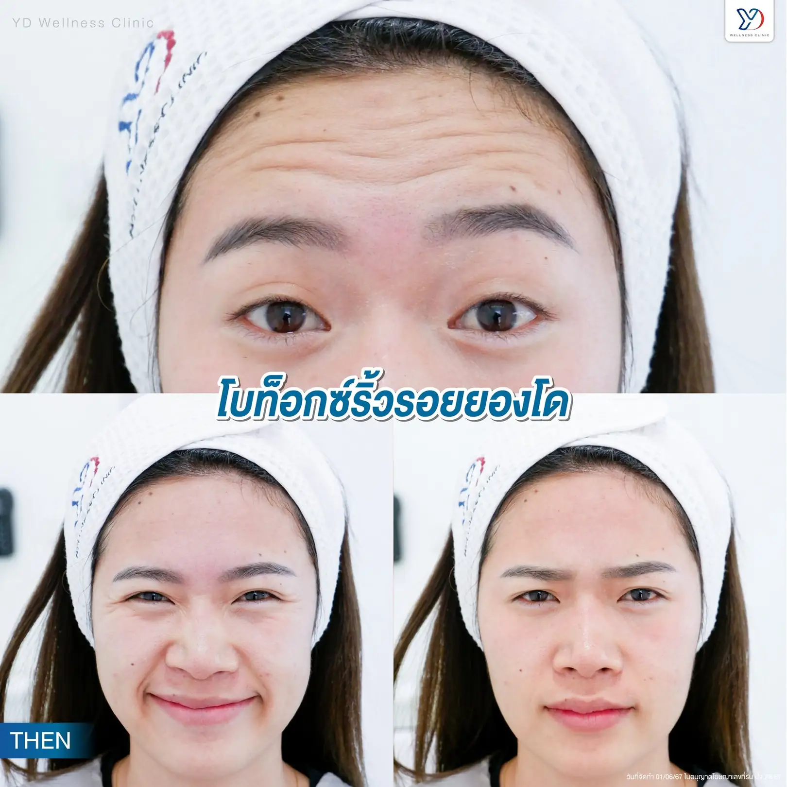 รีวิวโปรแกรมปรับหน้าอ่อนเยาว์ ที่ยองโด คลินิก 05