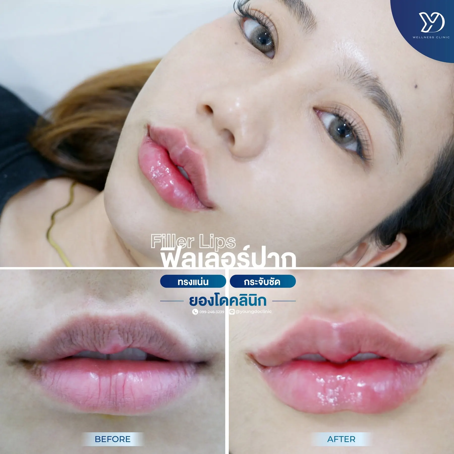 ฉีดปากสายฝอที่ ยองโด คลินิก สาขาปราจีนบุรี