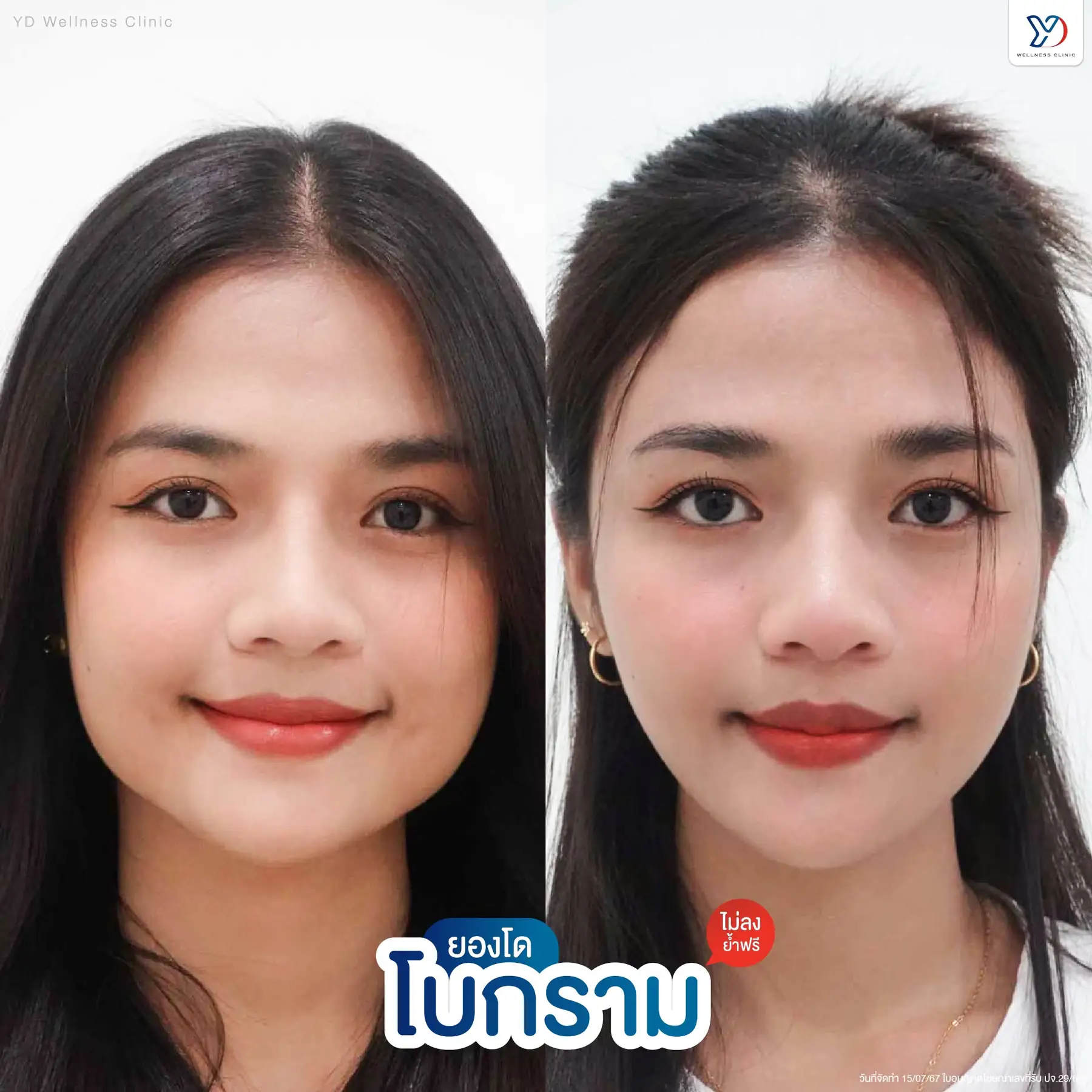 โบท็อกซ์ (Botox) คืออะไร