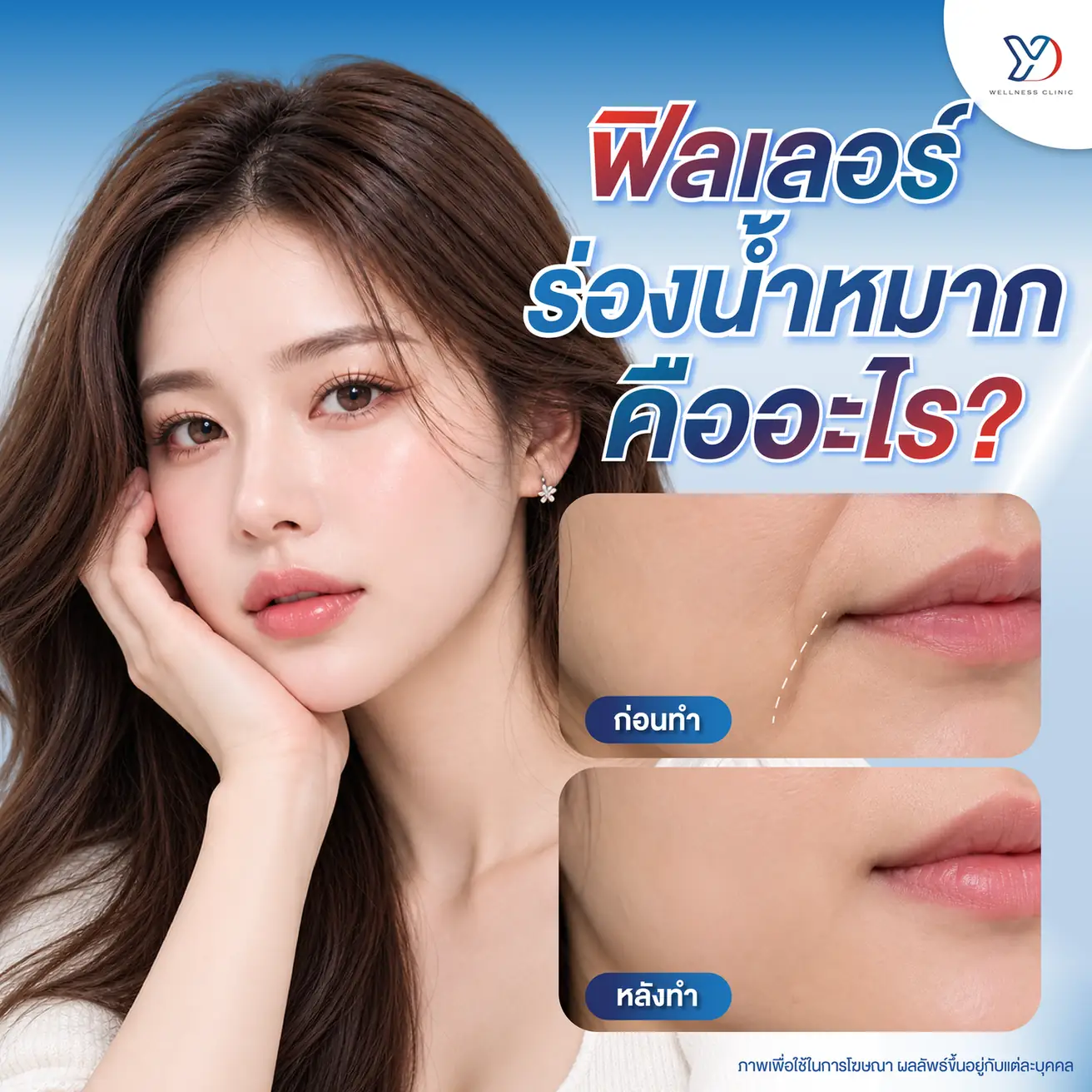 ฟิลเลอร์ร่องน้ำหมาก คืออะไร